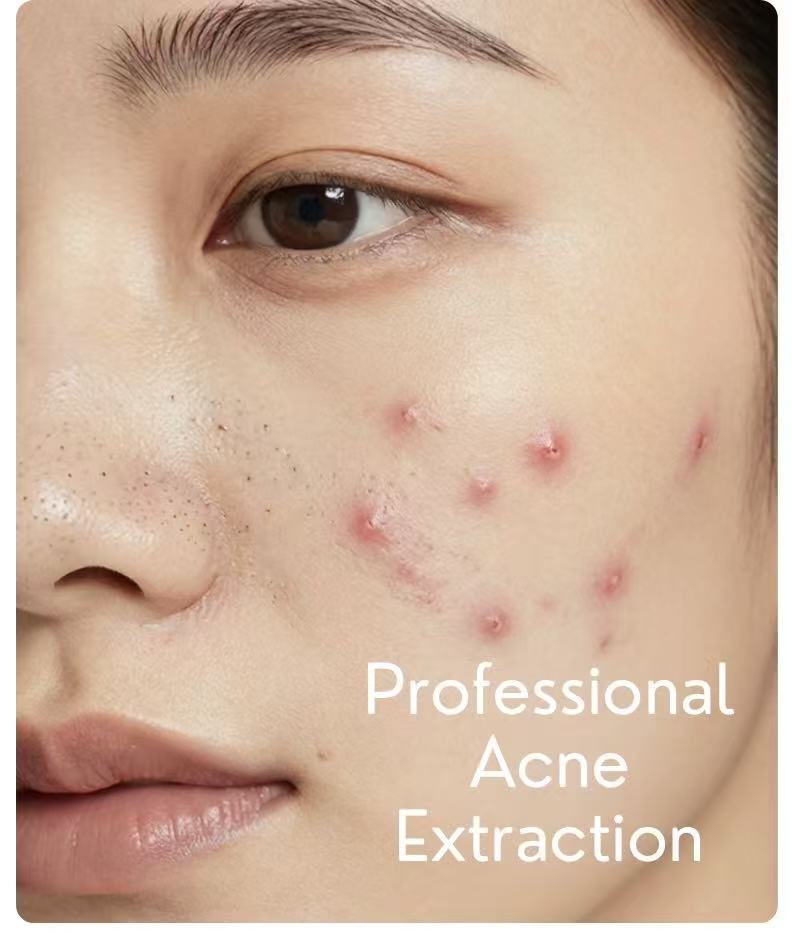 Acne-Prone Skin Care